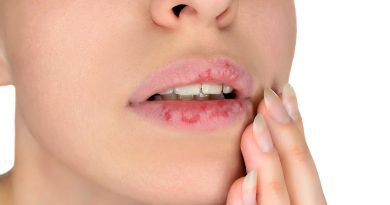 7 dalykai kas padaro jūsų lūpas sausomis